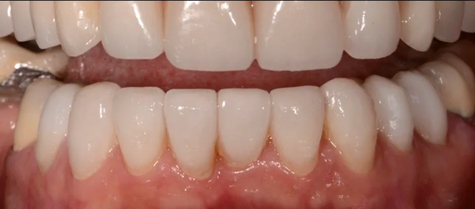 Veneers – after treatment, case 6 – Uptown Dentistry