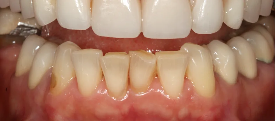 Veneers – before treatment, case 6 – Uptown Dentistry