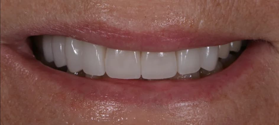 Veneers – after treatment, case 7 – Uptown Dentistry