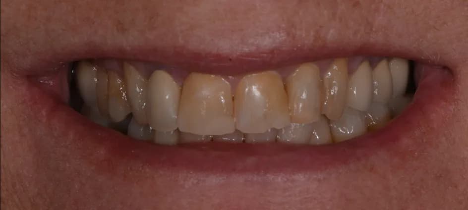 Veneers – before treatment, case 7 – Uptown Dentistry