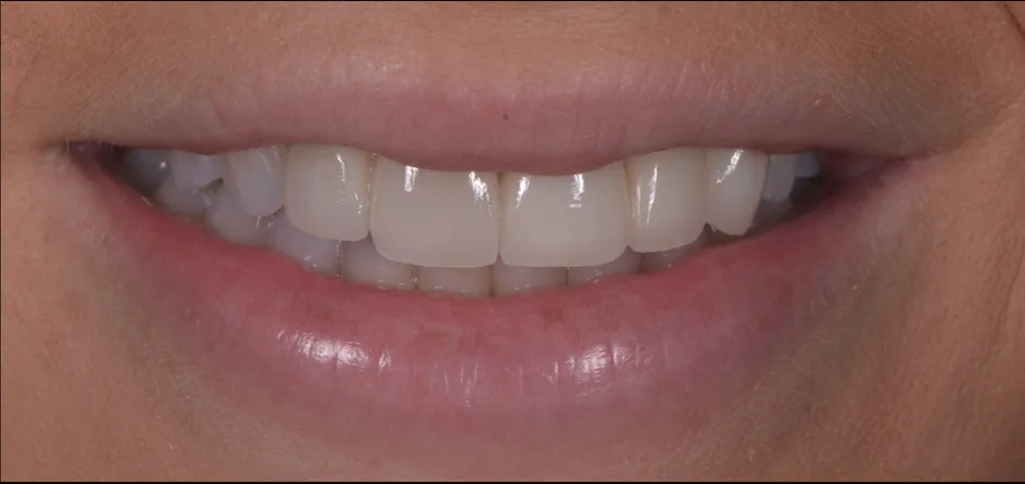 Veneers – after treatment, case 8 – Uptown Dentistry