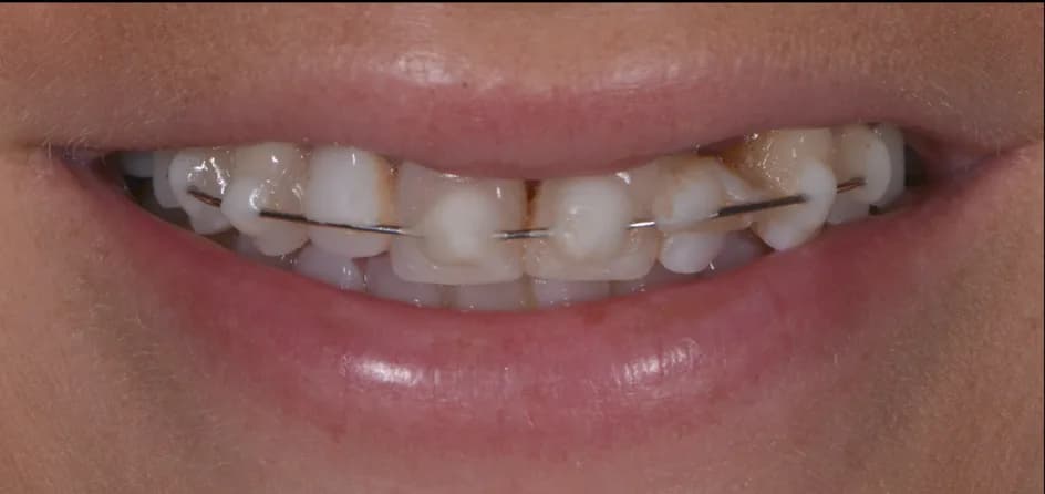 Veneers – before treatment, case 8 – Uptown Dentistry