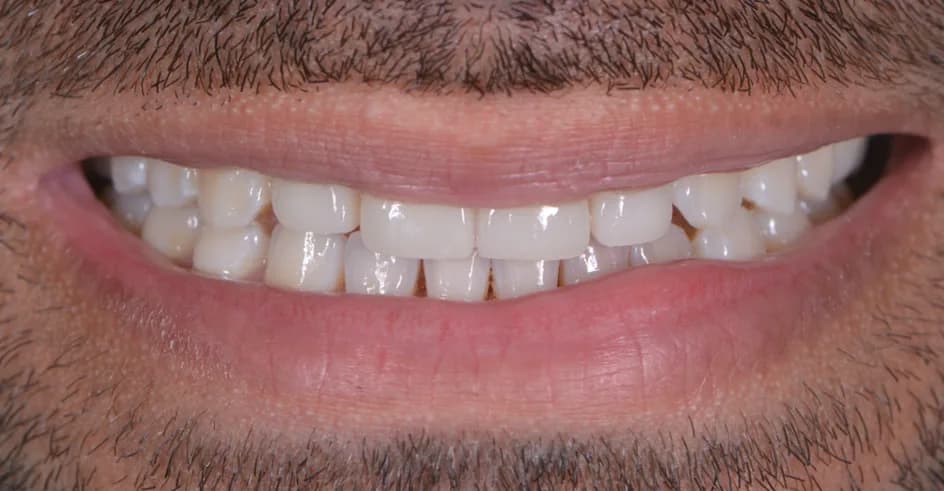 Veneers – after treatment, case 9 – Uptown Dentistry
