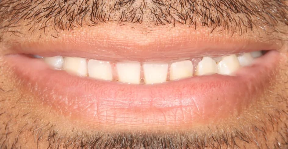 Veneers – before treatment, case 9 – Uptown Dentistry