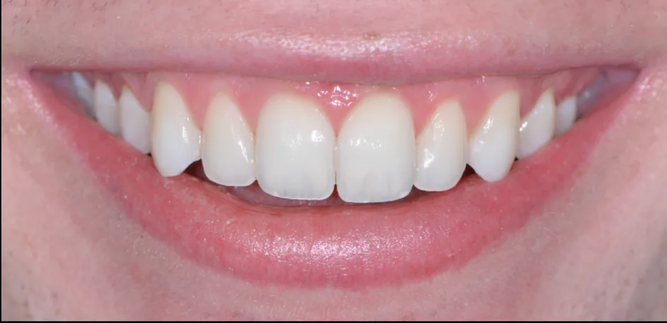 Whitening – after treatment, case 1 – Uptown Dentistry