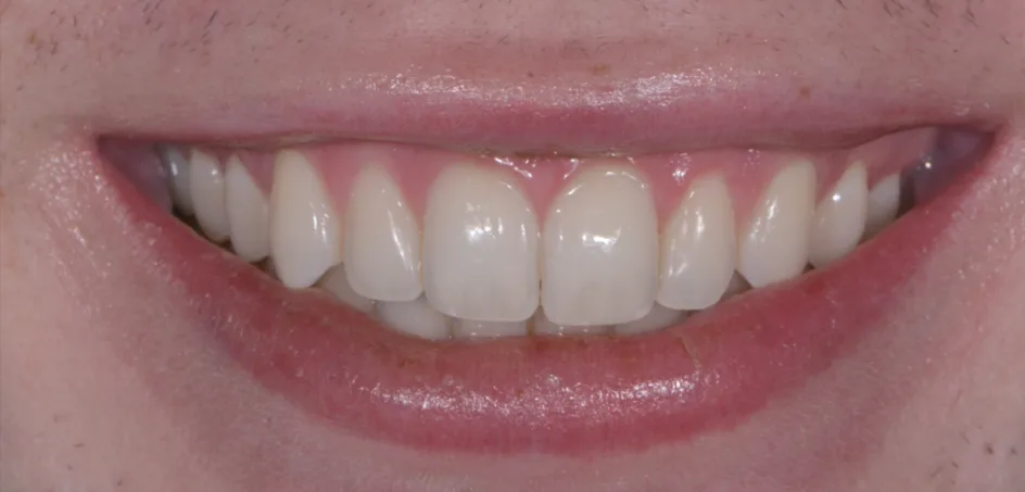 Whitening – before treatment, case 1 – Uptown Dentistry