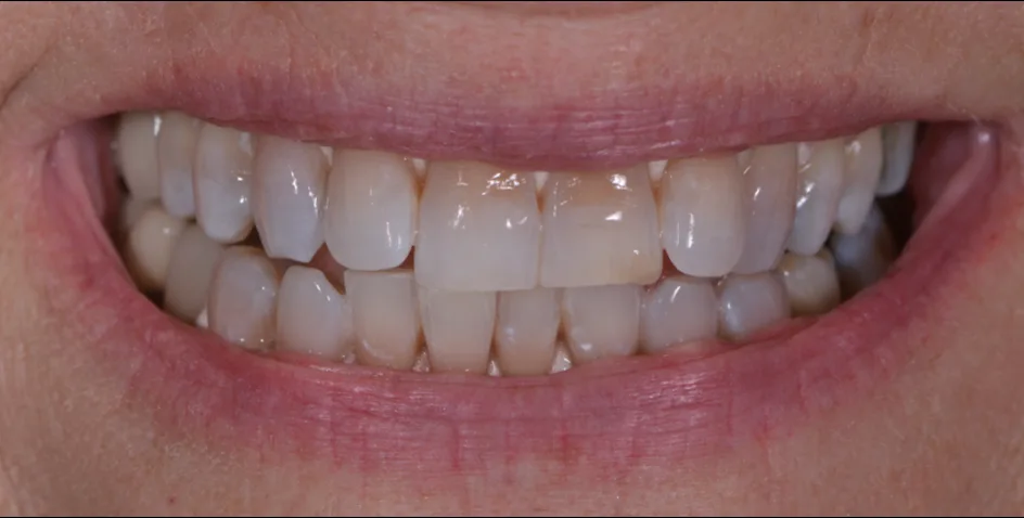 Whitening – after treatment, case 2 – Uptown Dentistry