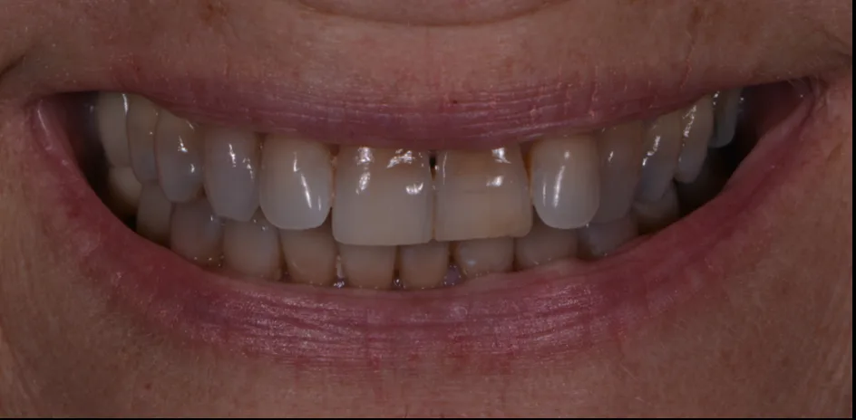 Whitening – before treatment, case 2 – Uptown Dentistry