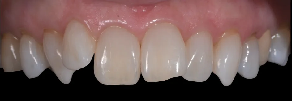 Whitening – after treatment, case 3 – Uptown Dentistry