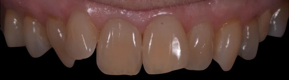 Whitening – before treatment, case 3 – Uptown Dentistry