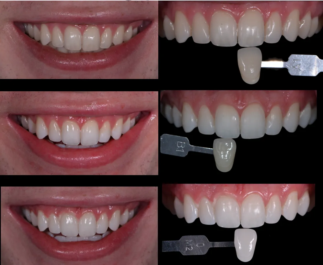 Teeth Whitening 101: How to Safely Get a Brighter, Whiter Smile