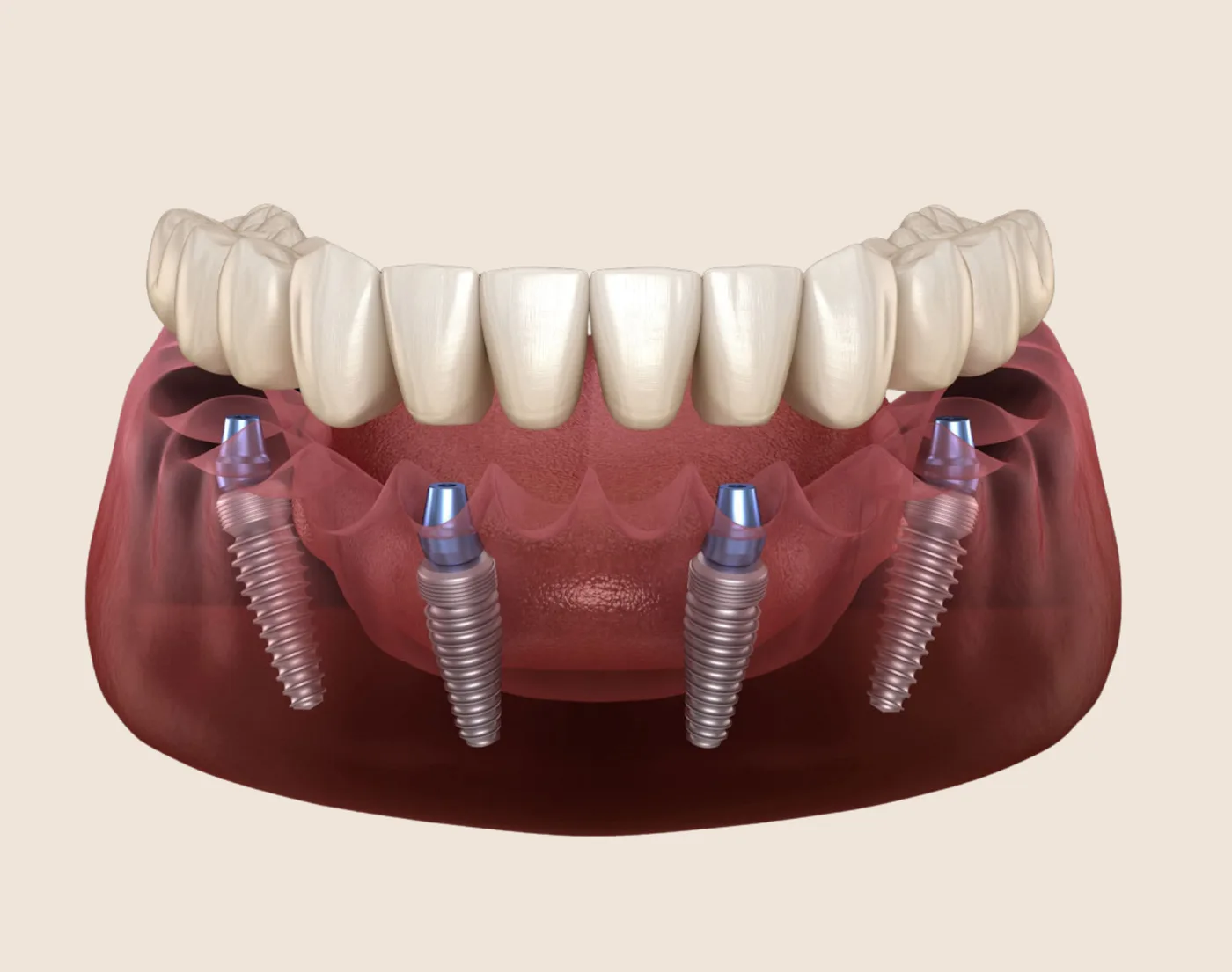 All-on-X Dental Implants in the Upper East Side, New York – Uptown Dentistry