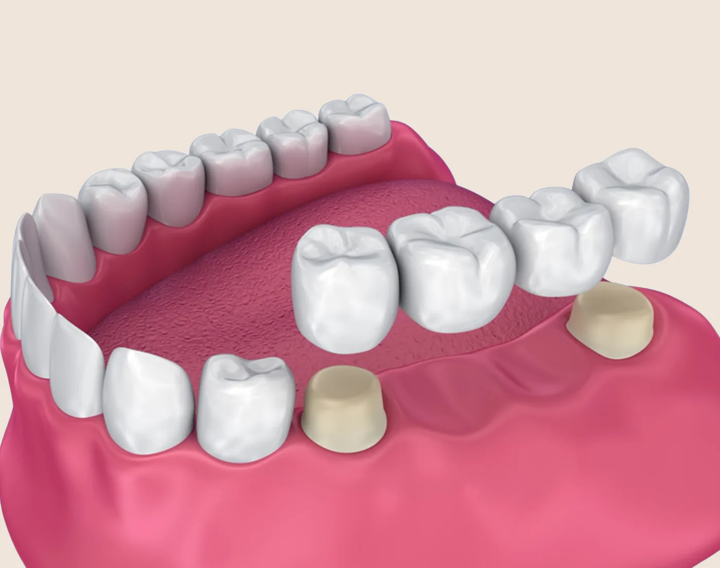Dental Bridges in the Upper East Side, New York – Uptown Dentistry