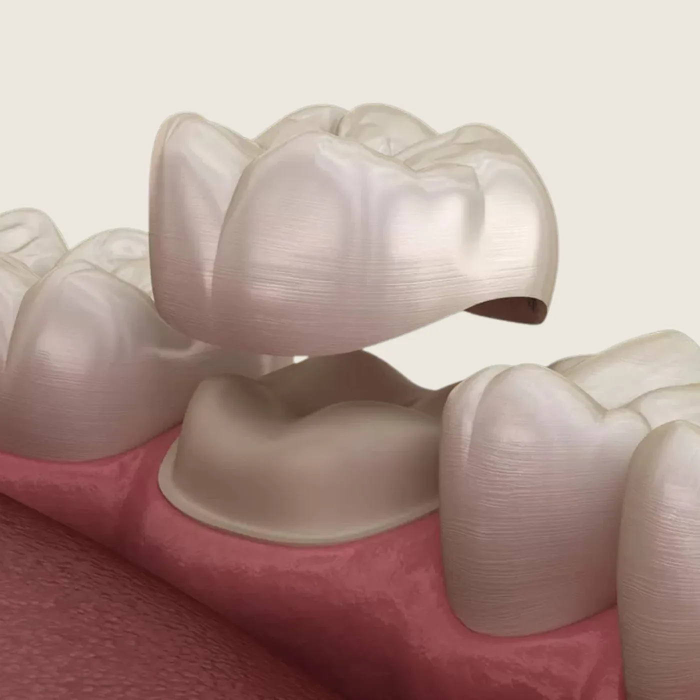 Dental Crowns in the Upper East Side, New York – Uptown Dentistry