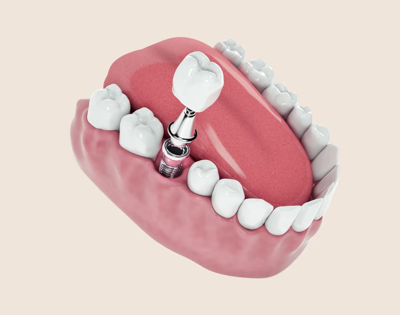 Dental Implants in the Upper East Side, New York – Uptown Dentistry