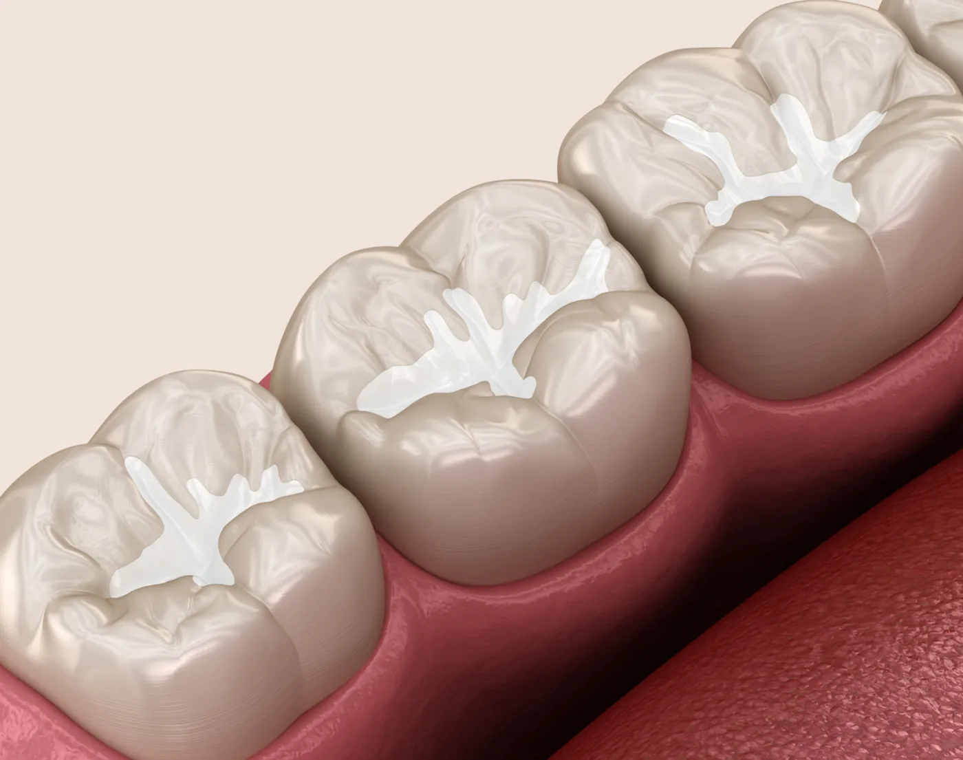 Dental Sealants in the Upper East Side, New York – Uptown Dentistry