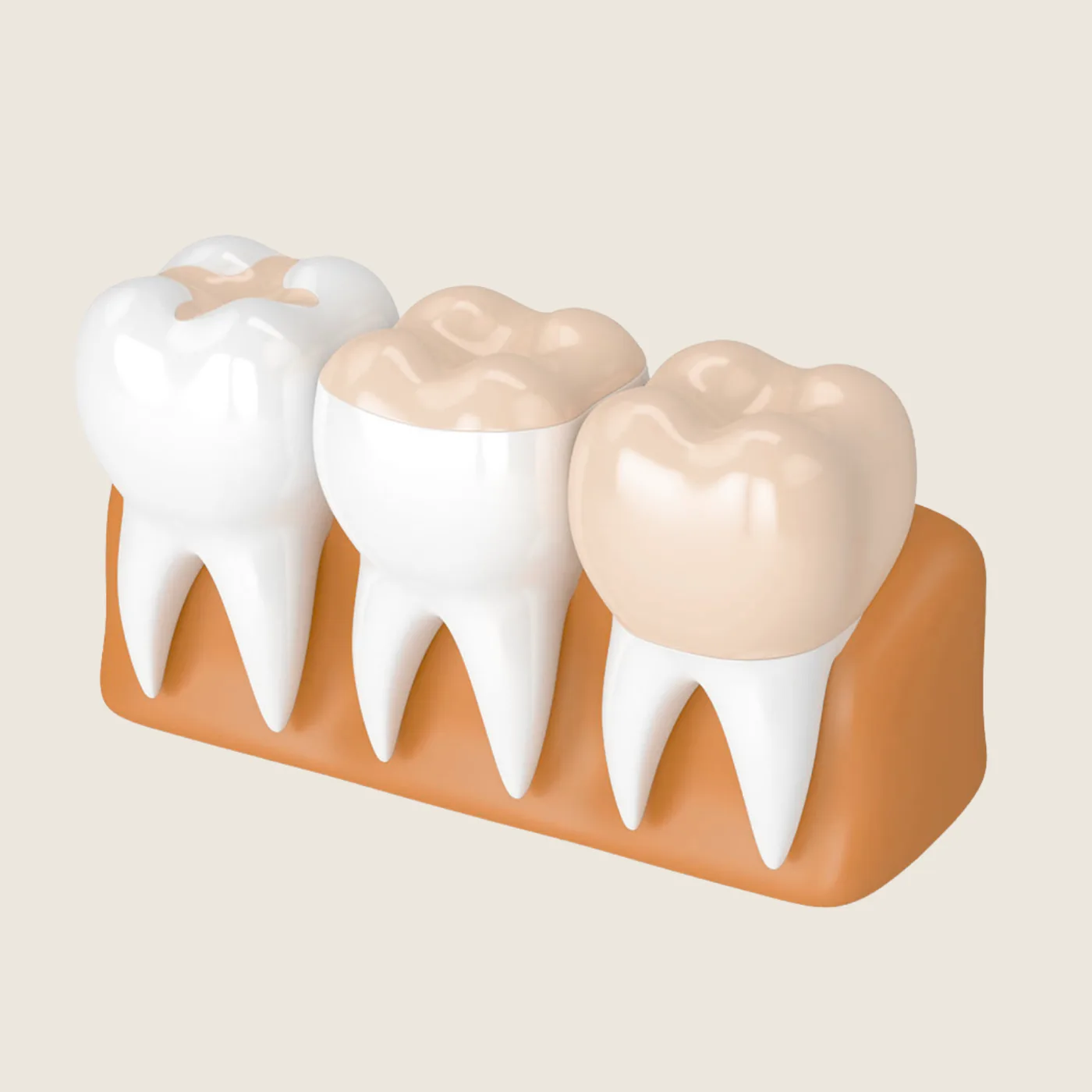 Inlays and Onlays in the Upper East Side, New York – Uptown Dentistry