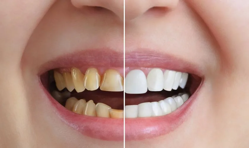 KöR Teeth Whitening in the Upper East Side, New York – Uptown Dentistry