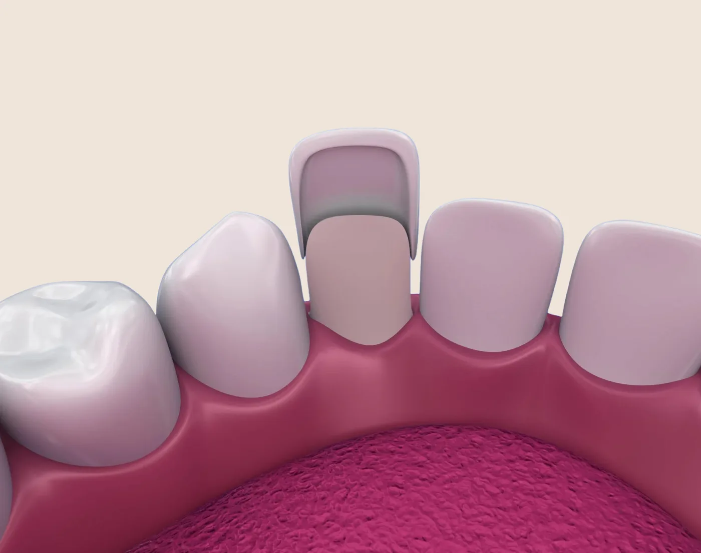 Porcelain Veneers in the Upper East Side, New York – Uptown Dentistry