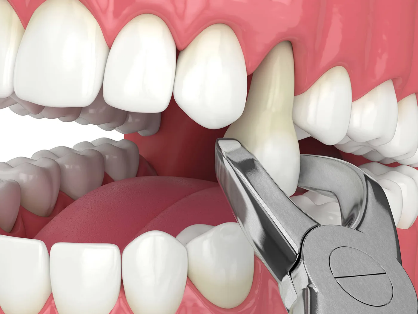 Tooth Extractions in the Upper East Side, New York – Uptown Dentistry